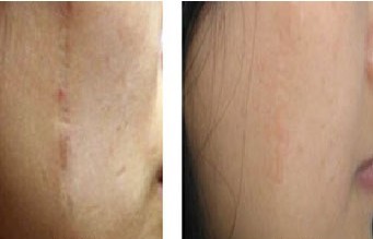 面部疤痕修復(fù)——翟小姐