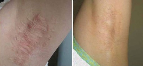 腋下疤痕修復(fù)——凌女士