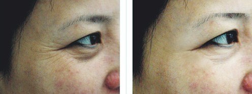 注射去除魚尾紋——吳女士