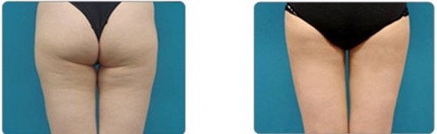 臀部吸脂——榮小姐