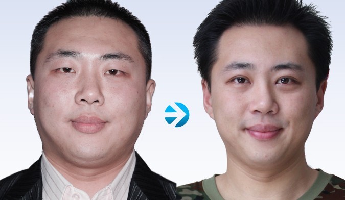 面部吸脂——張先生