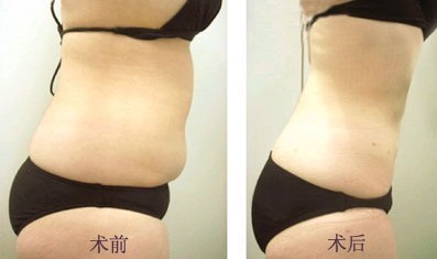 腹部吸脂——劉女士