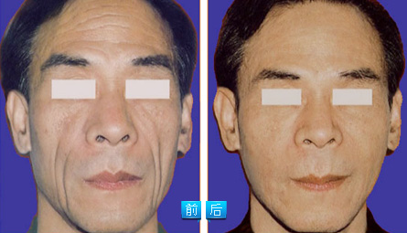 botox除皺之祛除法令紋——馮先生