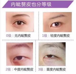 內(nèi)眥贅皮
