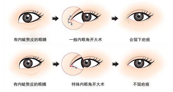 開(kāi)眼角-林賢超