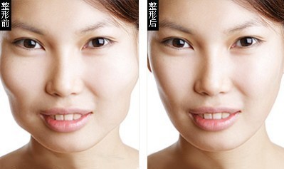 下頜角整形——鄭女士