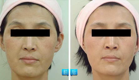 射頻緊膚之消除抬頭紋——林女士