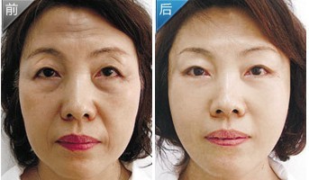 手術(shù)除皺——張女士