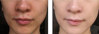 激光去黃褐斑——?jiǎng)⑿〗? /></a></div>
                        <span><h1><a href=