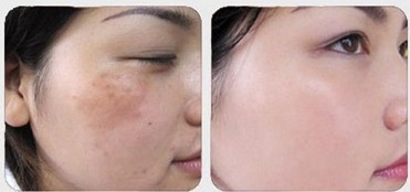 激光去黃褐斑——彭女士