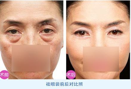 去眼袋案例效果-林賢超