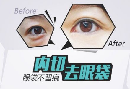 內(nèi)切祛眼袋.jpg