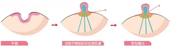 乳頭內(nèi)陷手術(shù).jpg