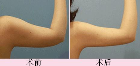 手臂吸脂.jpg