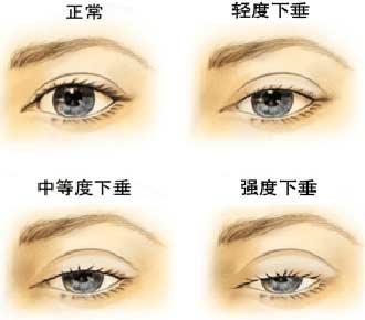 上瞼下垂.jpg