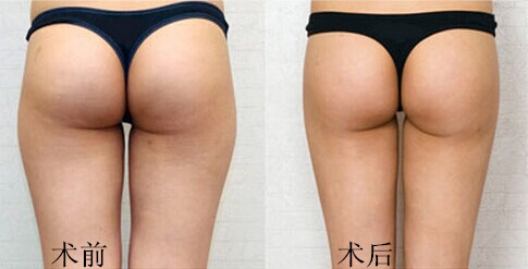 臀部吸脂.jpg