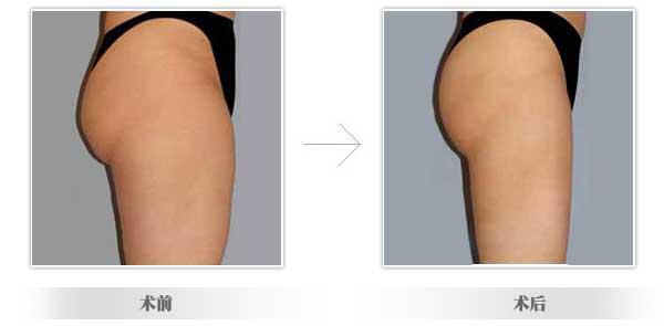 臀部吸脂.jpg