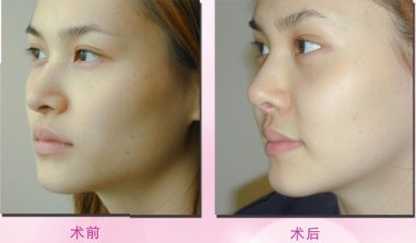 面部填充——伍小姐