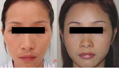 面部填充——榮女士