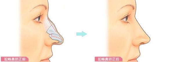 駝峰鼻手術(shù).jpg