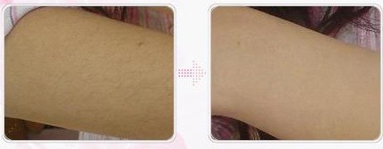 上臂脫毛——孫小姐