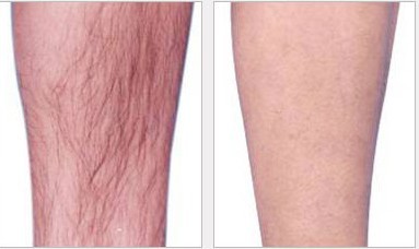 小腿冰點(diǎn)脫毛——?jiǎng)⑾壬? /></a></div>
                        <span><h1><a href=