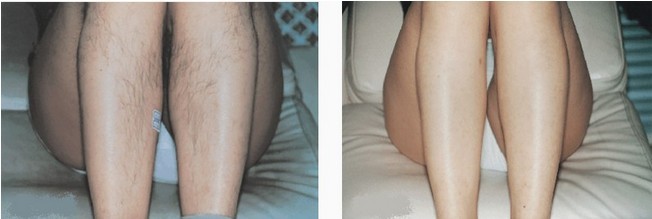 小腿冰點(diǎn)脫毛——王小姐