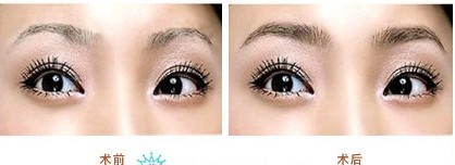 眉部整形——周小姐