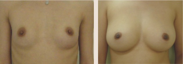 麥格假體隆胸——?jiǎng)⑴? /></a></div>
                        <span><h1><a href=