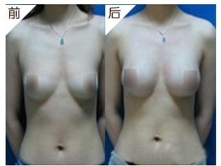 水滴形假體隆胸——?jiǎng)⑿〗? /></a></div>
                        <span><h1><a href=