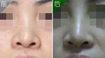 隆鼻失敗修復(fù)——李先生