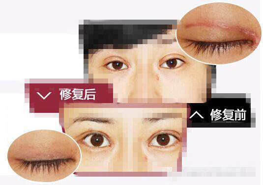 雙眼皮修復(fù).jpg