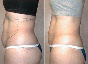 腰部吸脂案例-林賢超醫(yī)生